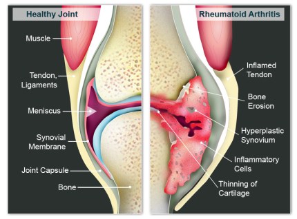 Rheumatoid-Arthritis model