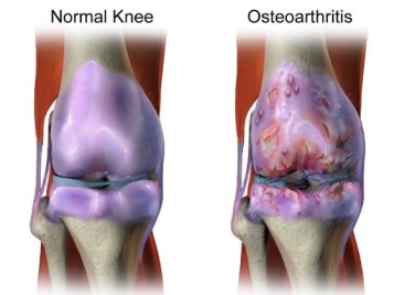 normal vs osteo knee